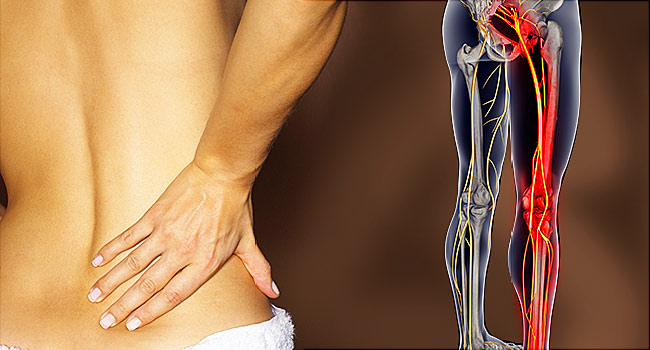 Banish Sciatica Pain with Physical Therapy Center